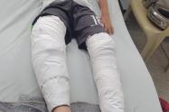 ¡Accidente! En Ibagué niño de 10 años se quemó las dos piernas tras regársele alcohol